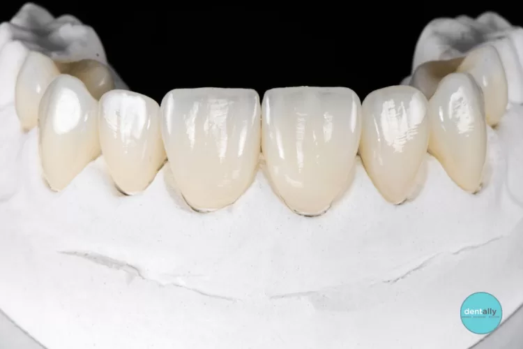 Veneers in India vs. Australia_ Cost, Quality & Results Compared