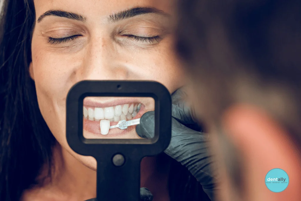 What is the Cost of Veneers for Two Front Teeth in India? -  Dentally
