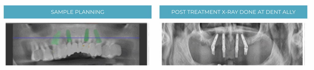 cost of All-on-4 dental implants in India